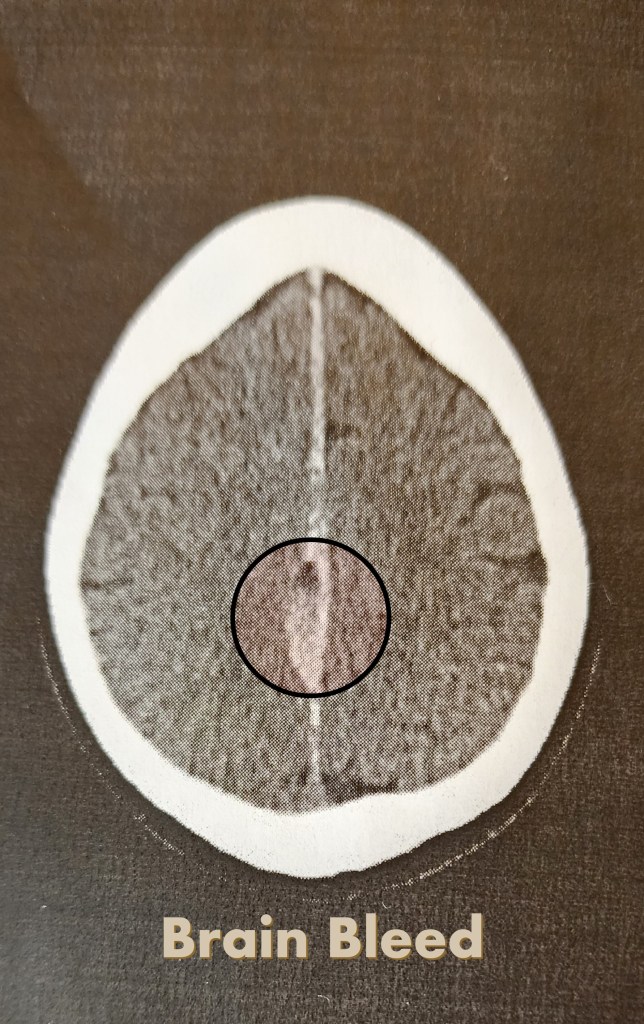 Axial CT scan of the brain used by doctors to assess concussion severity after a fall showing a brain bleed