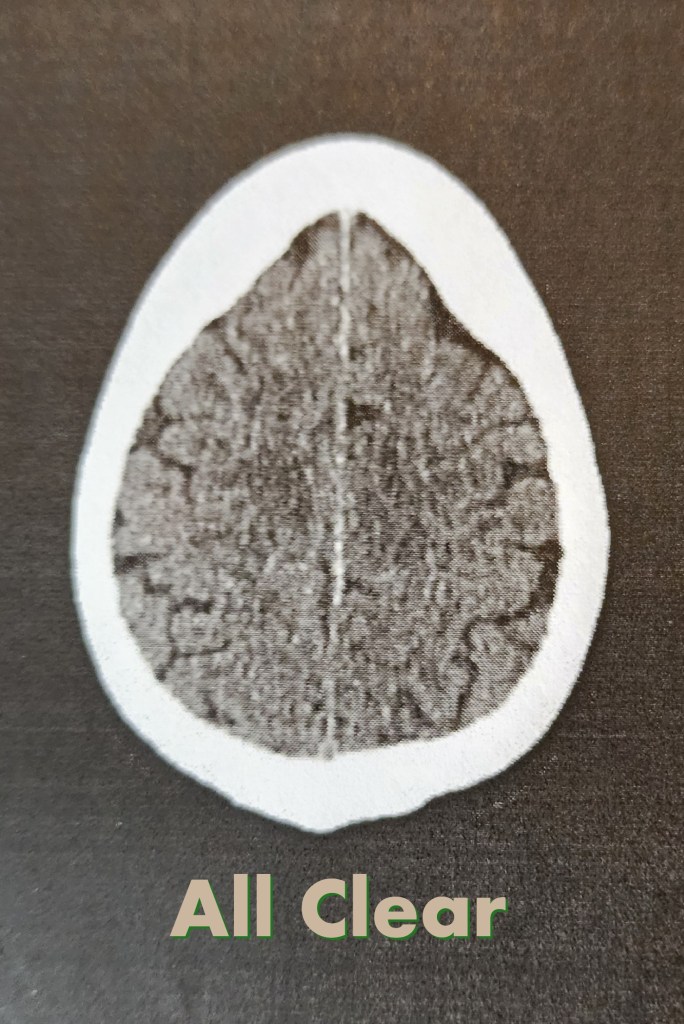 Brain CT imaging performed after head trauma to monitor concussion recovery